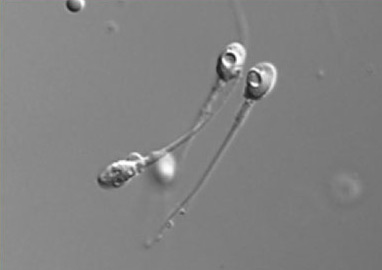iniezione intra-citoplasmatica di uno spermatozoo morfologicamente selezionato